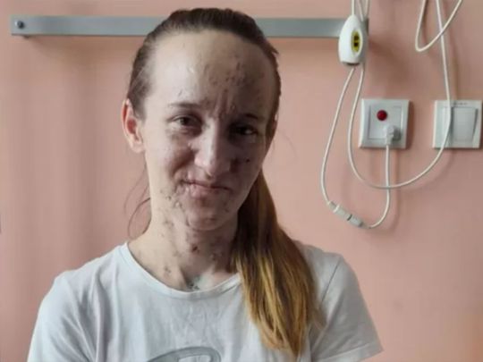 Бачила лише розмиті силуети: у Польщі врятували зір українці, яка майже осліпла через обстріл окупантів