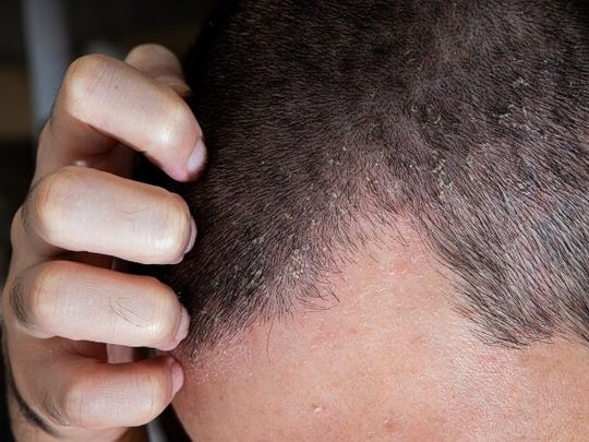 «Що більше пацієнт розчісує, то гірше картина»: лікарка розповіла про себорейний дерматит